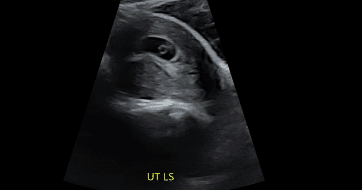 8 week ultrasound 2022